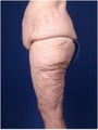 Lower Body Lift after Massive Weight Loss (Gastric Bypass)