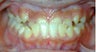 Teen Orthodontic Treatment (case #3MM)