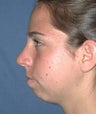 Chin Augmentation