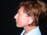 Endoscopic Brow Lift