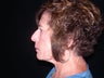 Endoscopic Brow Lift