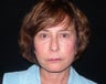 Lower Facelift
