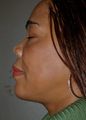Chin Surgery, Chin Augmentation, Double Chin