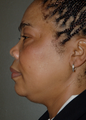 Chin Surgery, Chin Augmentation, Double Chin