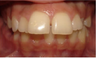 Invisalign Treatment
