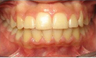 Invisalign Treatment
