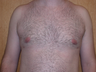 Male Breast Reduction