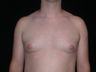 Male Breast Reduction