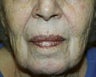 Deep chemical peel of the perioral region