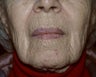 Deep chemical peel of the perioral region
