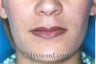 Lip Augmentation