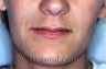 Lip Augmentation