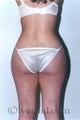 Liposuction