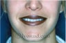 Lip Augmentation