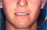 Lip Augmentation