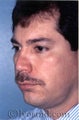 Facial Plastic Surgery