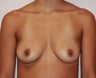 Breast Implants