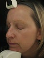Fraxel Dual Laser (Only 1927 laser, one treatment)