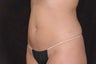 Body-Jet Water Assisted Liposuction for Abdomen