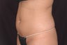 Body-Jet Water Assisted Liposuction for Abdomen