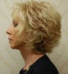 Facelift