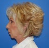 Facelift