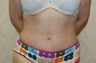 Tummy Tuck