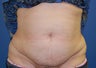 Tummy Tuck