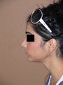 rhinoplasty