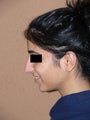 rhinoplasty