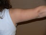 Arm lift/reduction