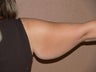Arm lift/reduction