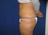 Tummy Tuck