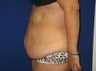 Tummy Tuck