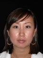 Lip enhancement