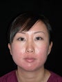 Lip enhancement