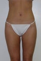 liposuction