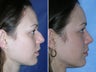 Rhinoplasty
