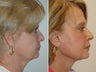 Facelift