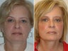 Facelift