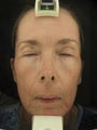 Fraxel Dual 1927 for Hyperpigmentation and wrinkles