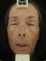 Fraxel Dual 1927 for Hyperpigmentation and wrinkles
