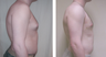Vaser Liposuction