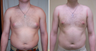 Vaser Liposuction