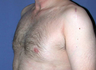 Male Breast Reduction