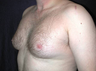 Male Breast Reduction