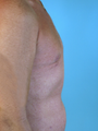 Male Breast Reduction