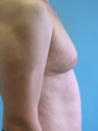 Male Breast Reduction