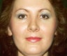 rhinoplasty