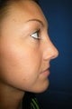 Rhinoplasty